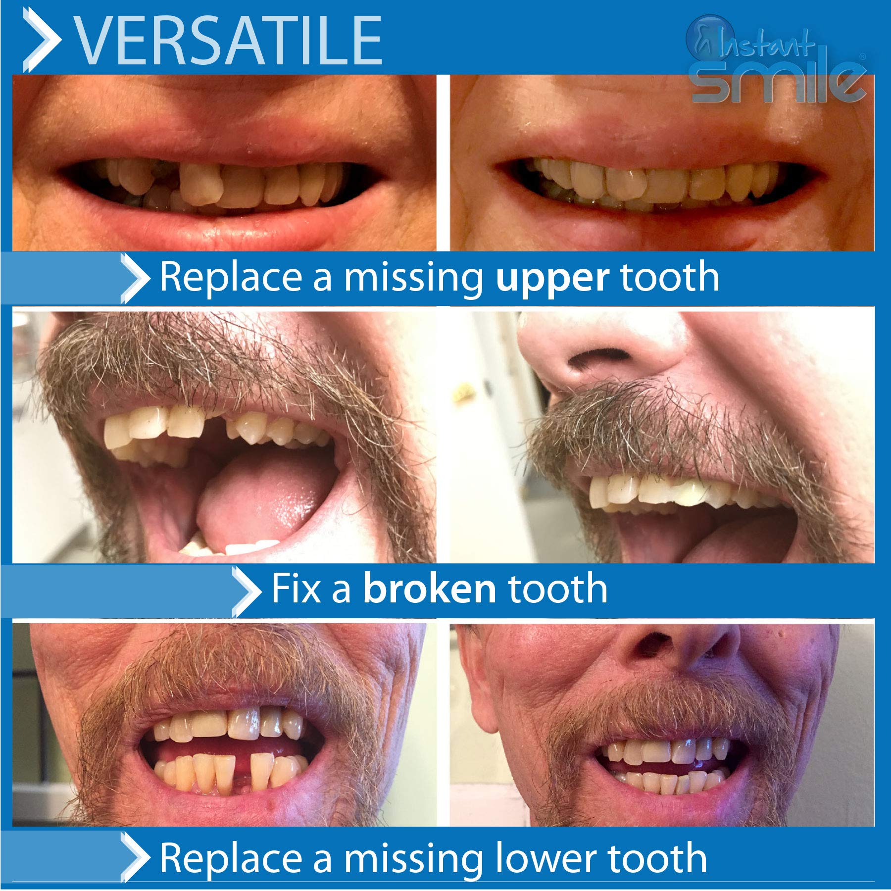 Patented temporary tooth molded in the shape of an actual tooth