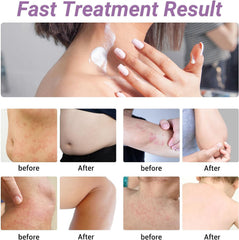 ishancare urticaria cream quick absorption on skin during use