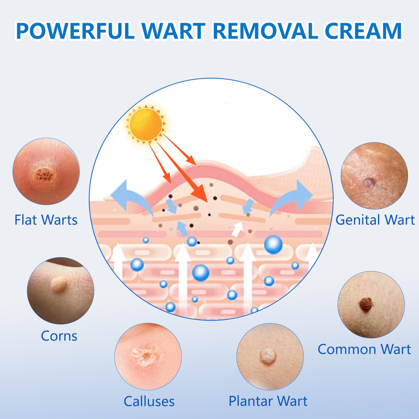 KIbabyDI Wart Remover application tip showing gentle cryotherapy