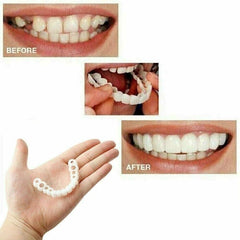 Contents of the at-home temporary smile kit