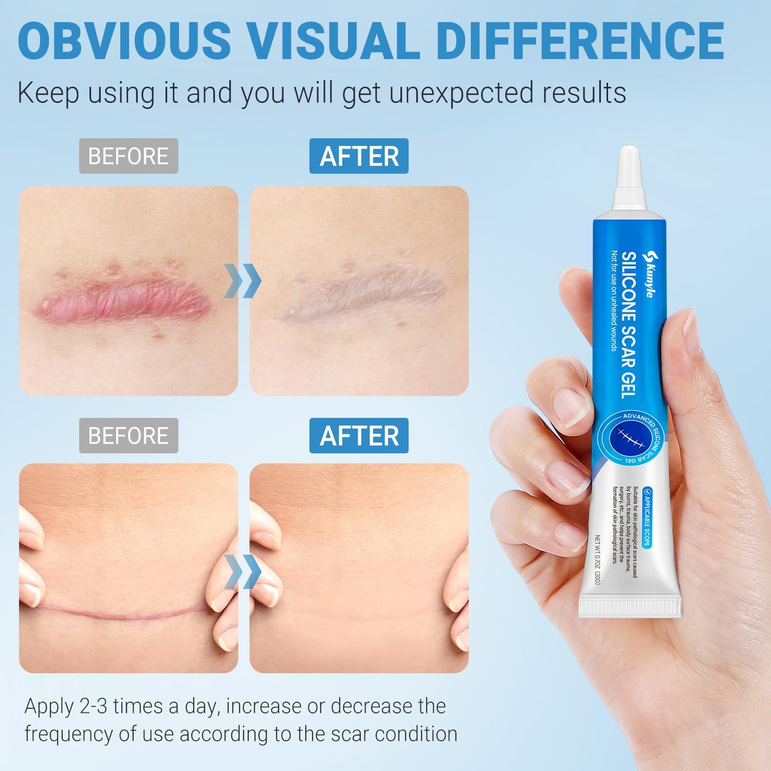 Kunyle silicone scar gel on a surgical scar showing improved texture.