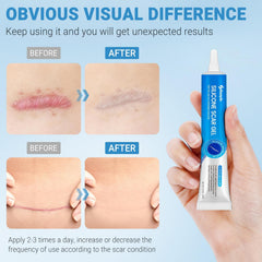Kunyle silicone scar gel on a surgical scar showing improved texture.