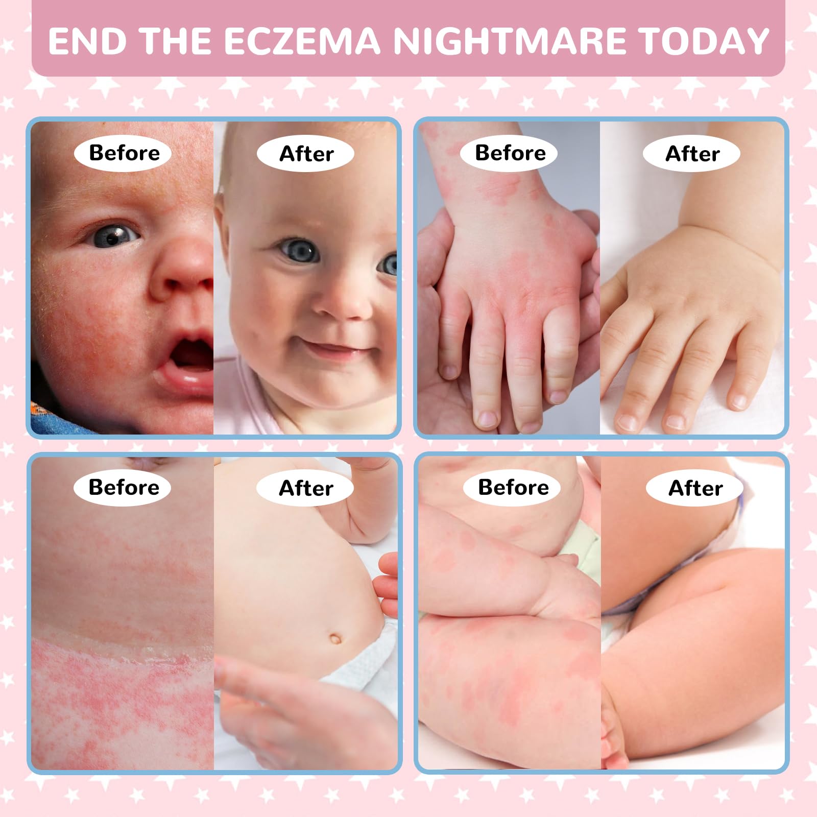 LMNOOP Baby Eczema Relief Cream applied to dry skin for comfort