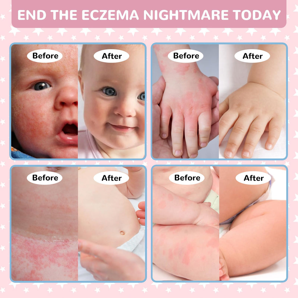 LMNOOP Baby Eczema Relief Cream applied to dry skin for comfort