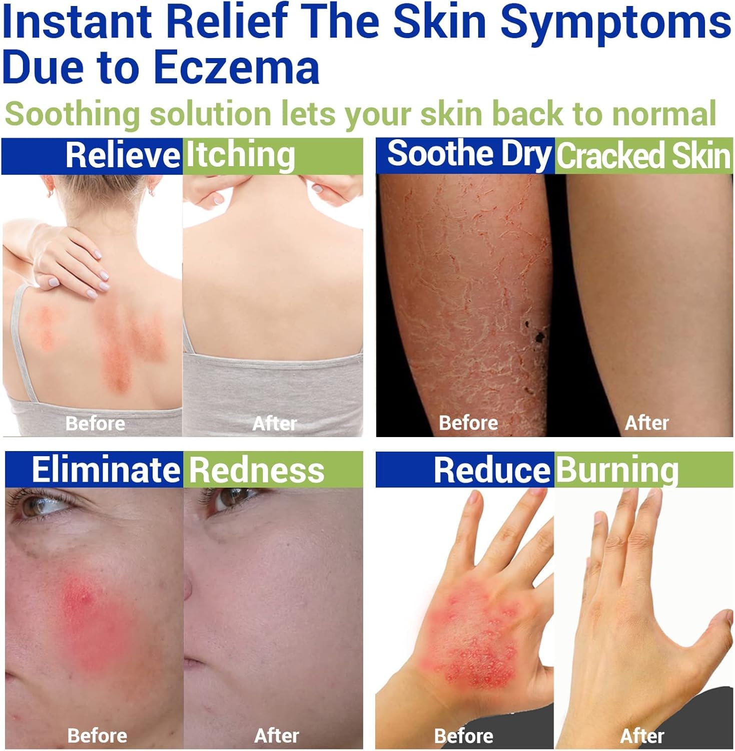 LMNOOP eczema cream application on hand demonstrates easy spot relief