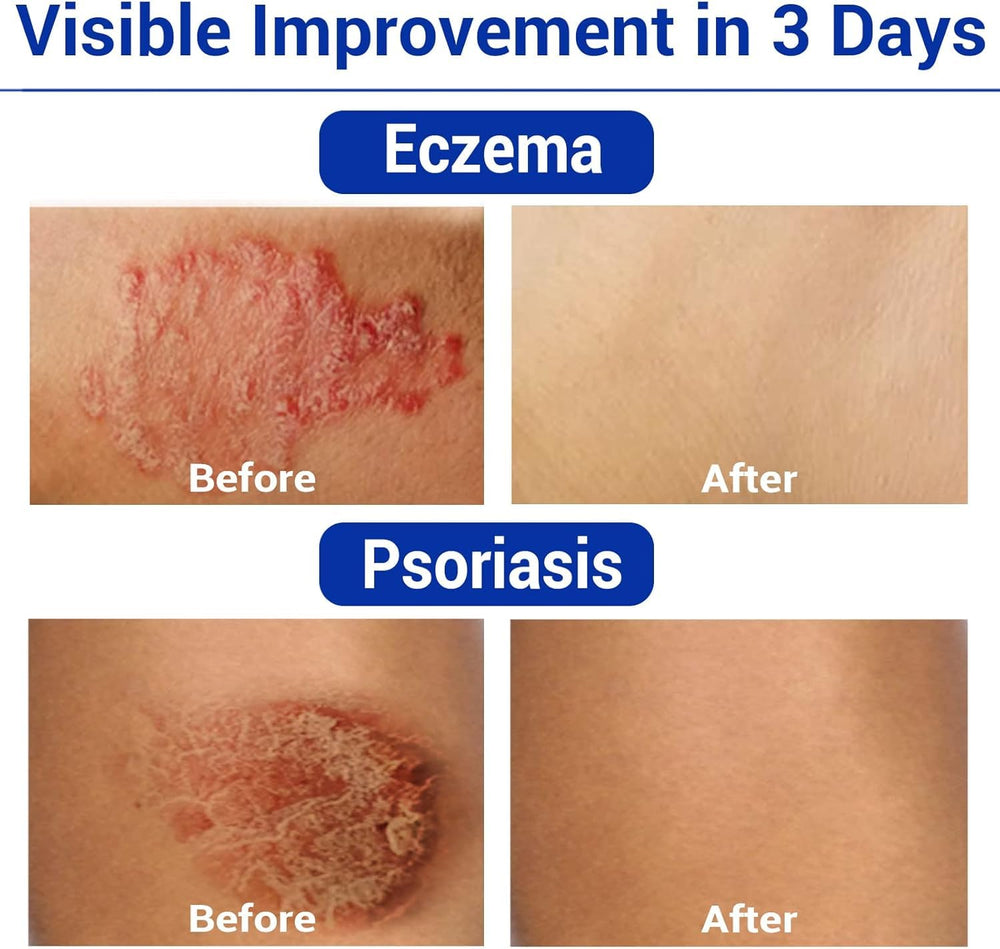 LMNOOP eczema cream patch on arm demonstrates rash-prone skin use