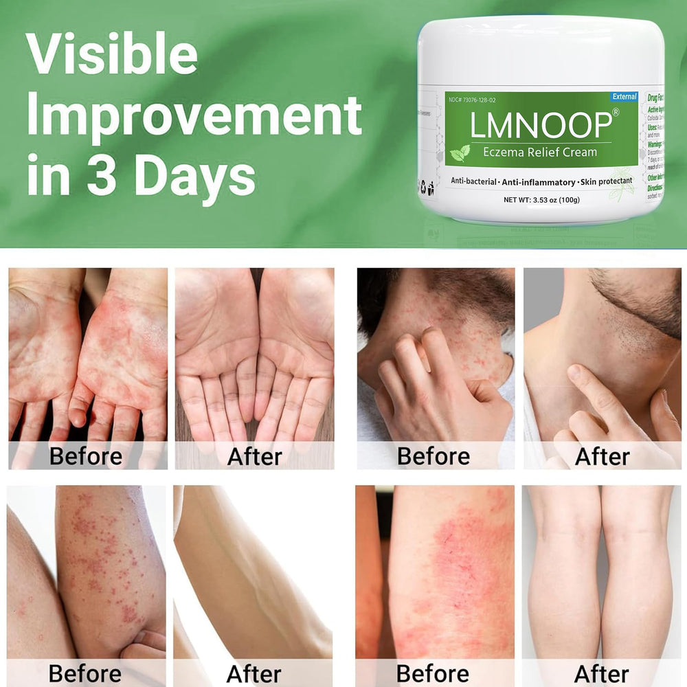 LMNOOP Eczema Therapy bottle demonstrates convenient squeeze for targeted care.