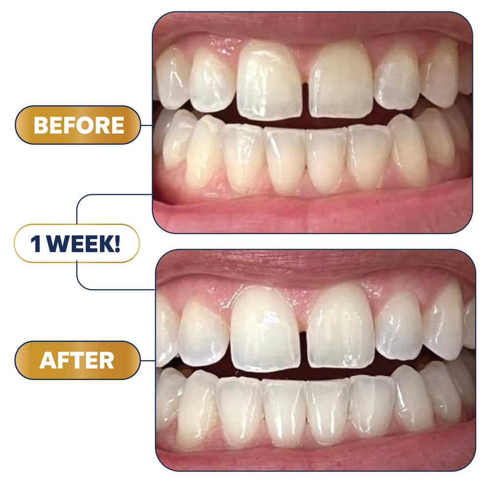 Lifestyle shot of white teeth after using Lumineux pen