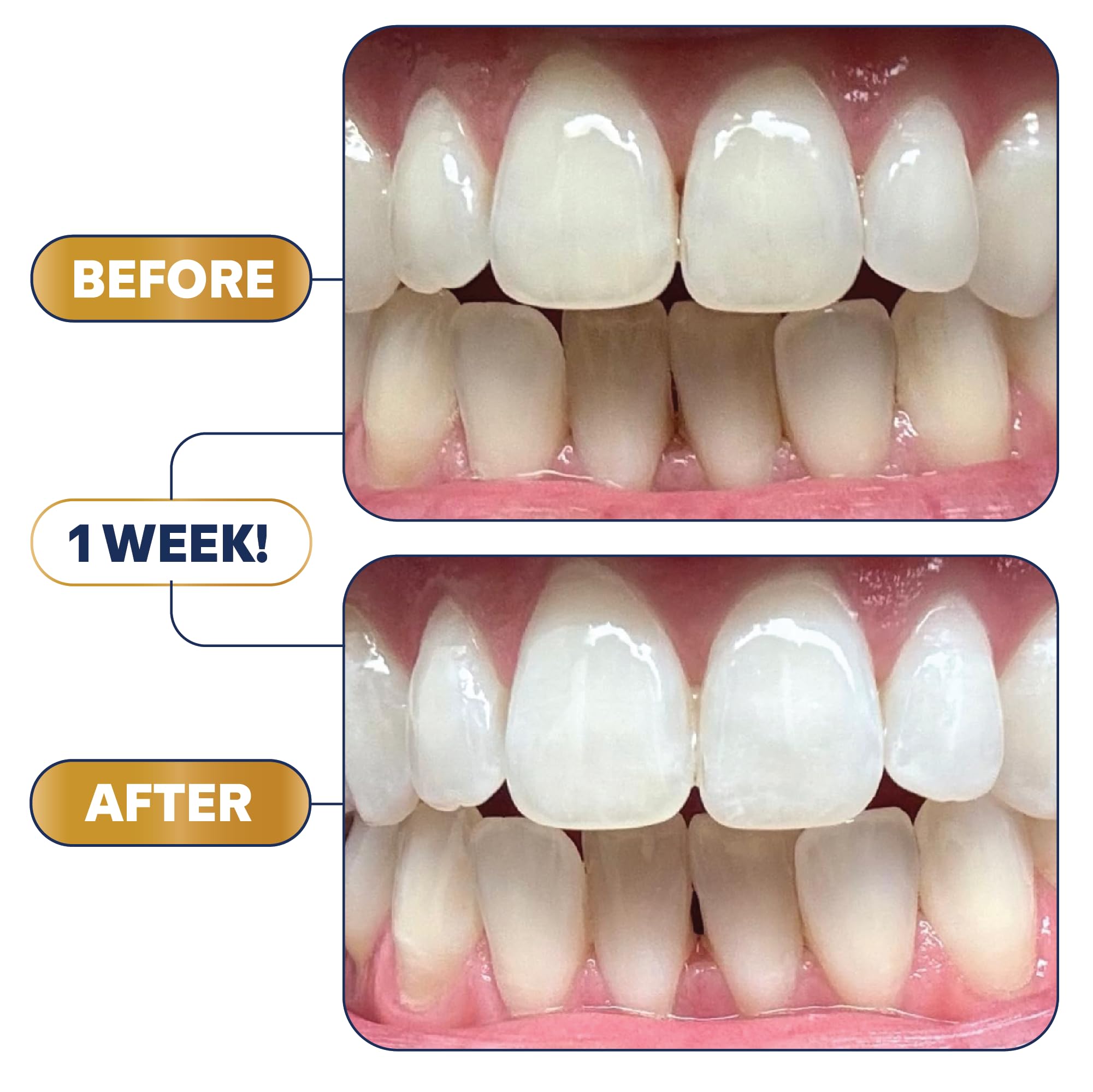 Before and after results with Lumineux Longevity Whitening Kit Bundle