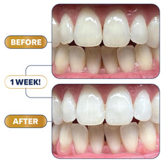 Before and after results with Lumineux Longevity Whitening Kit Bundle