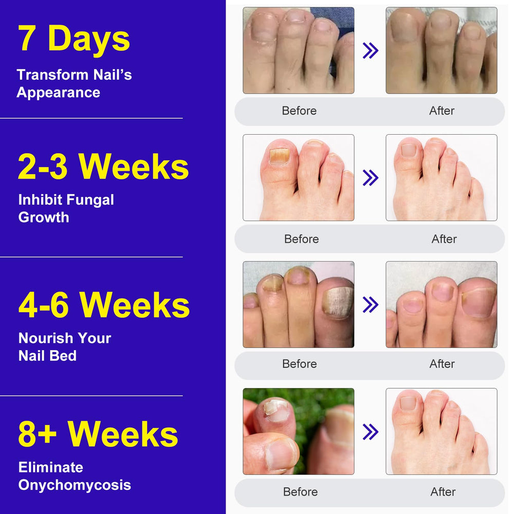 Marianp Toenail Patches night-time application demonstrates easy care routine.