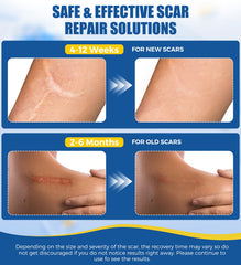 MasterMo reusable silicone scar sheets are washable and cost-effective.