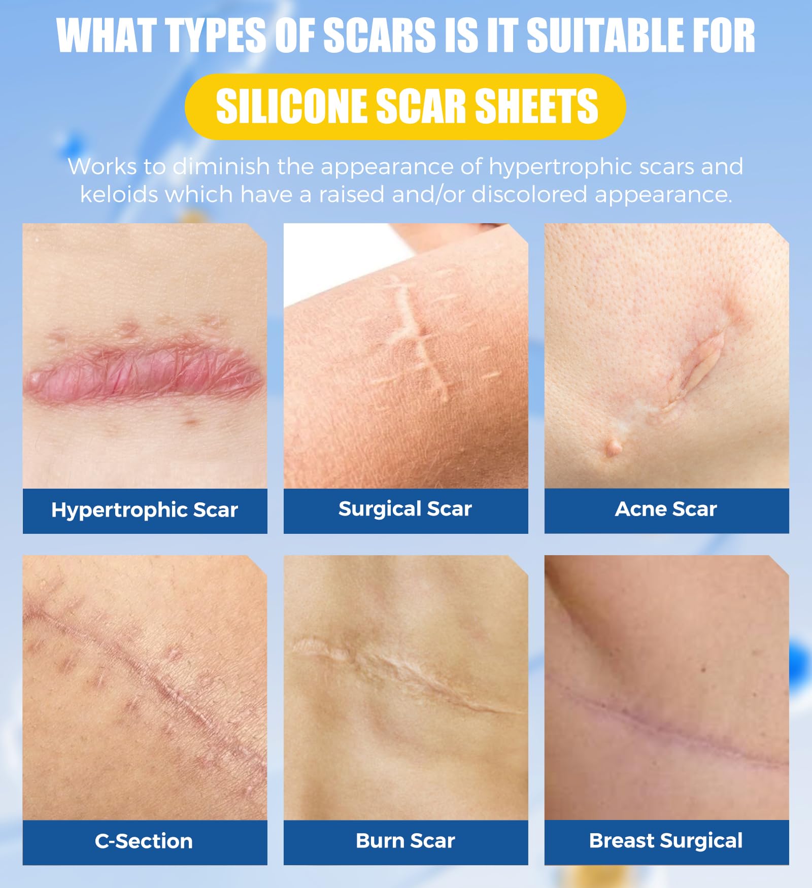 MasterMo scar tape provides a strong hold for daily activities.
