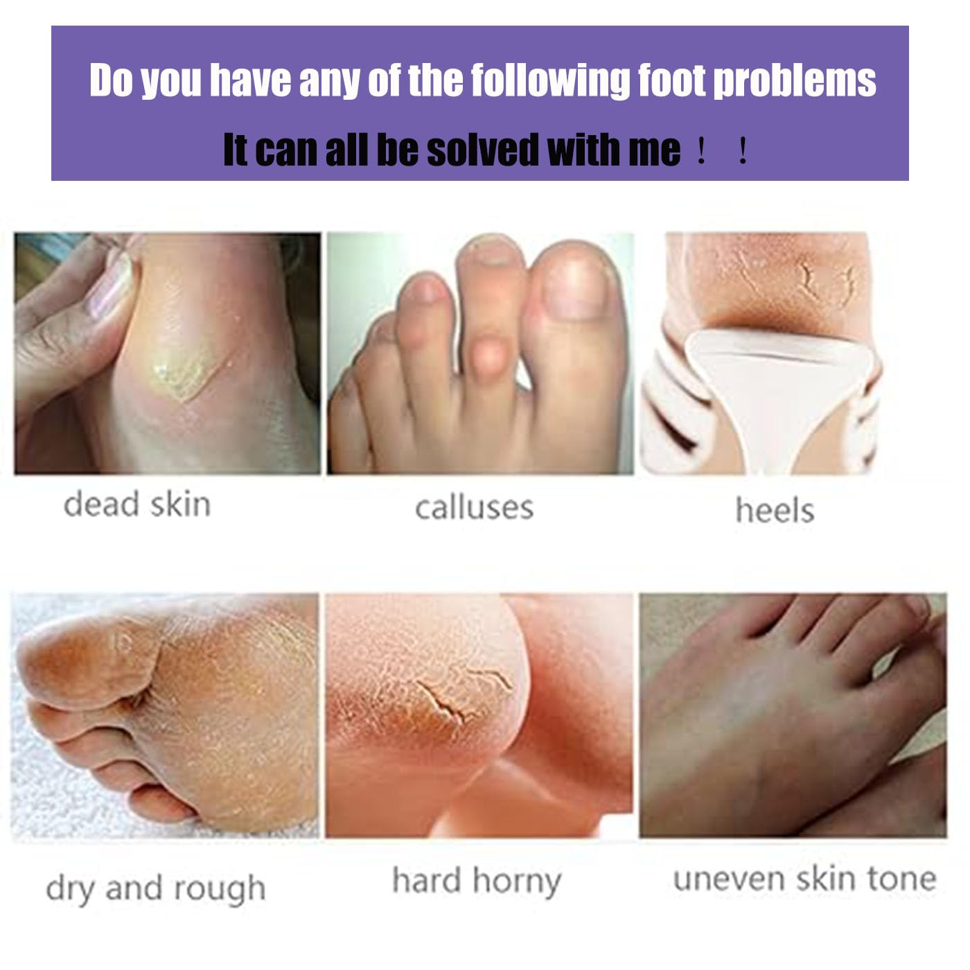 Mckkymi foot peel mask 5 pack after-use soft skin reveal