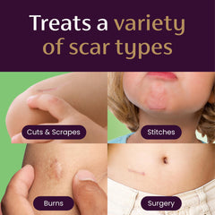 Mederma Scar Gel for Kids absorbs quickly without staining.