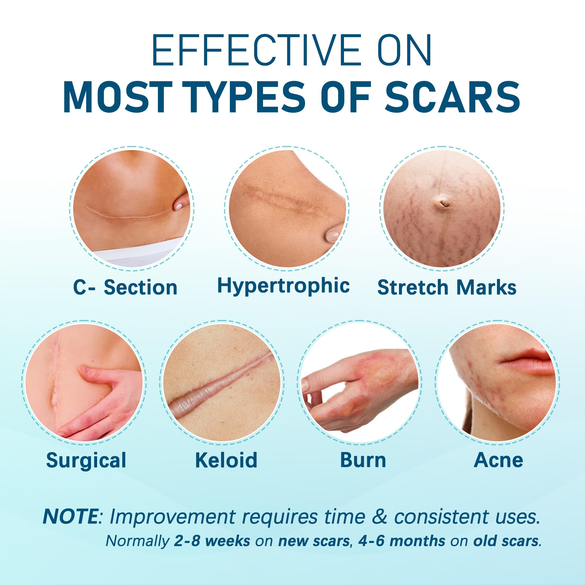 MEDLOT silicone scar sheets are washable and reusable for economical care.