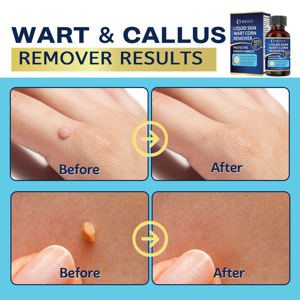 MEOLY wart remover ingredients label helps informed at-home use.