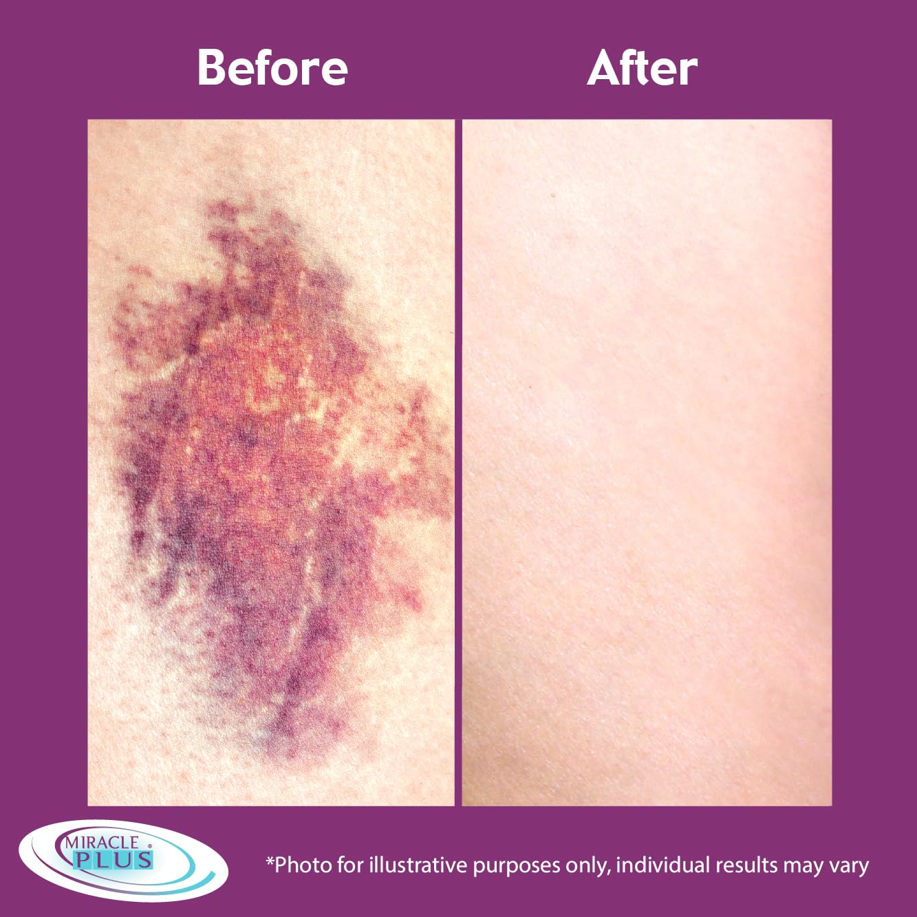 Miracle Plus Arnica Cream Vitamin K image highlights strengthening and bruising resilience.