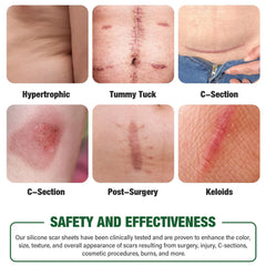 Mitreal silicone scar sheets on skin with flat, discreet wear under clothing