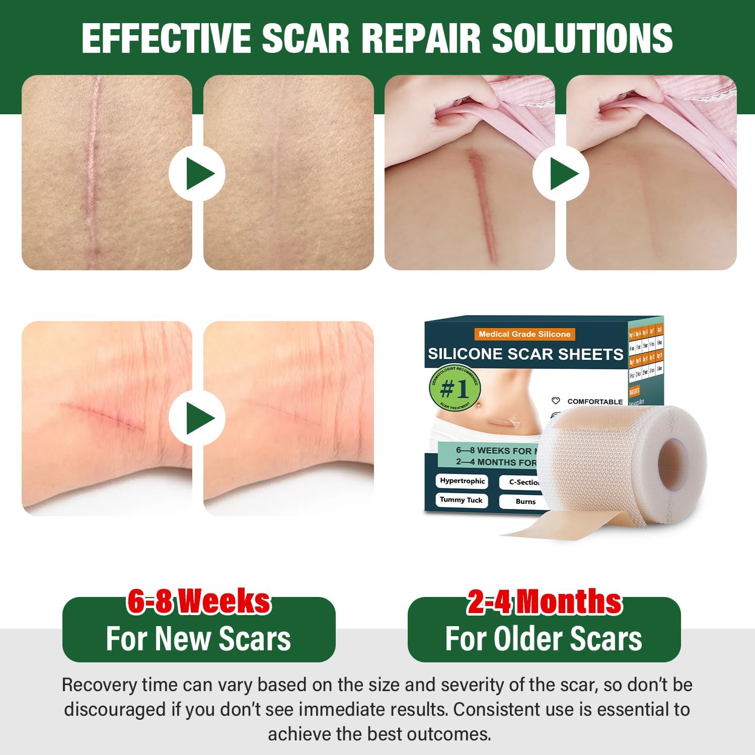 Mitreal silicone scar sheets roll close-up showing extended-use roll