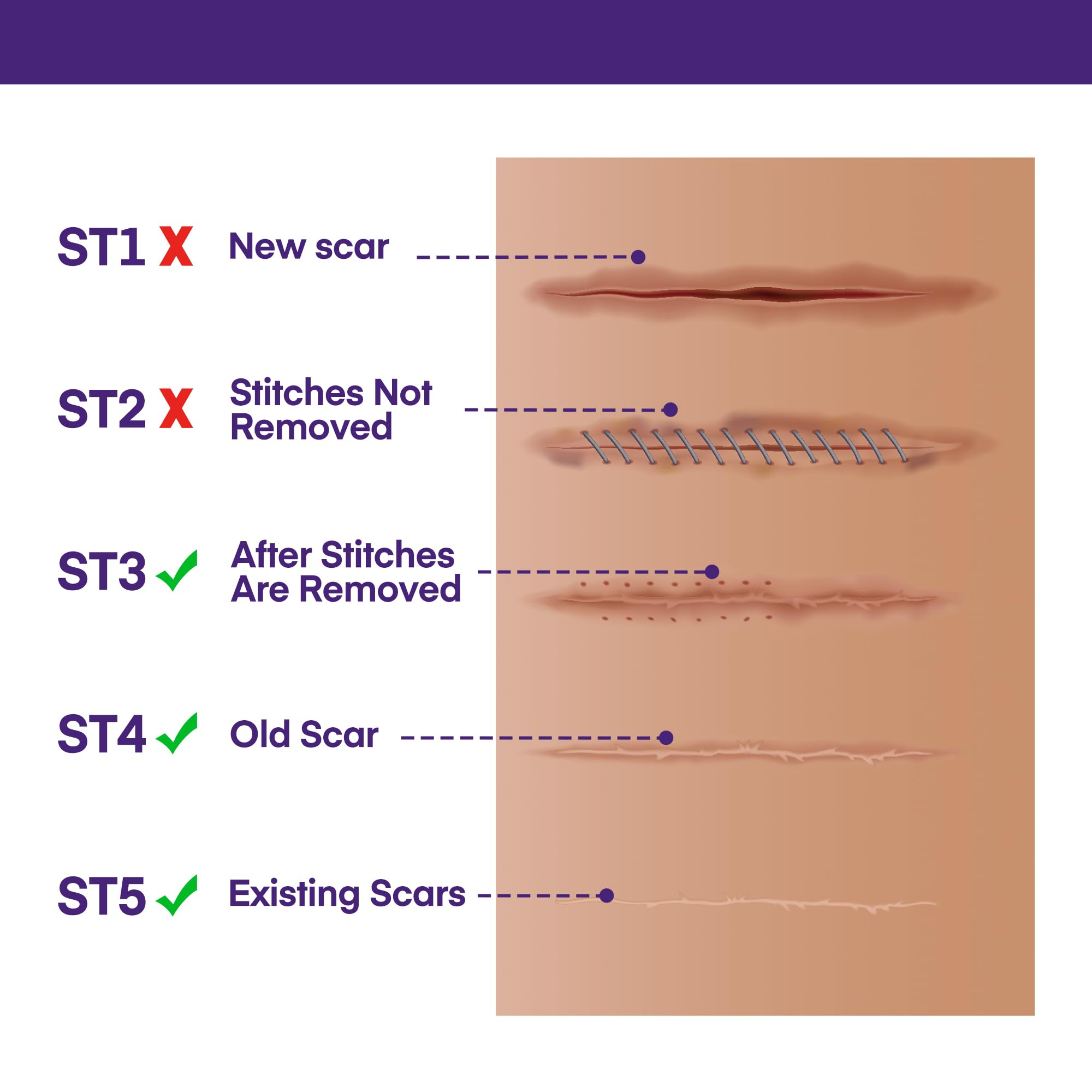 MURASAKI BEAUTY scar gel on skin near healing area.