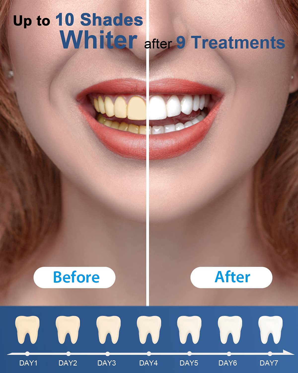 Package of MySmile refills with gel pens and tray