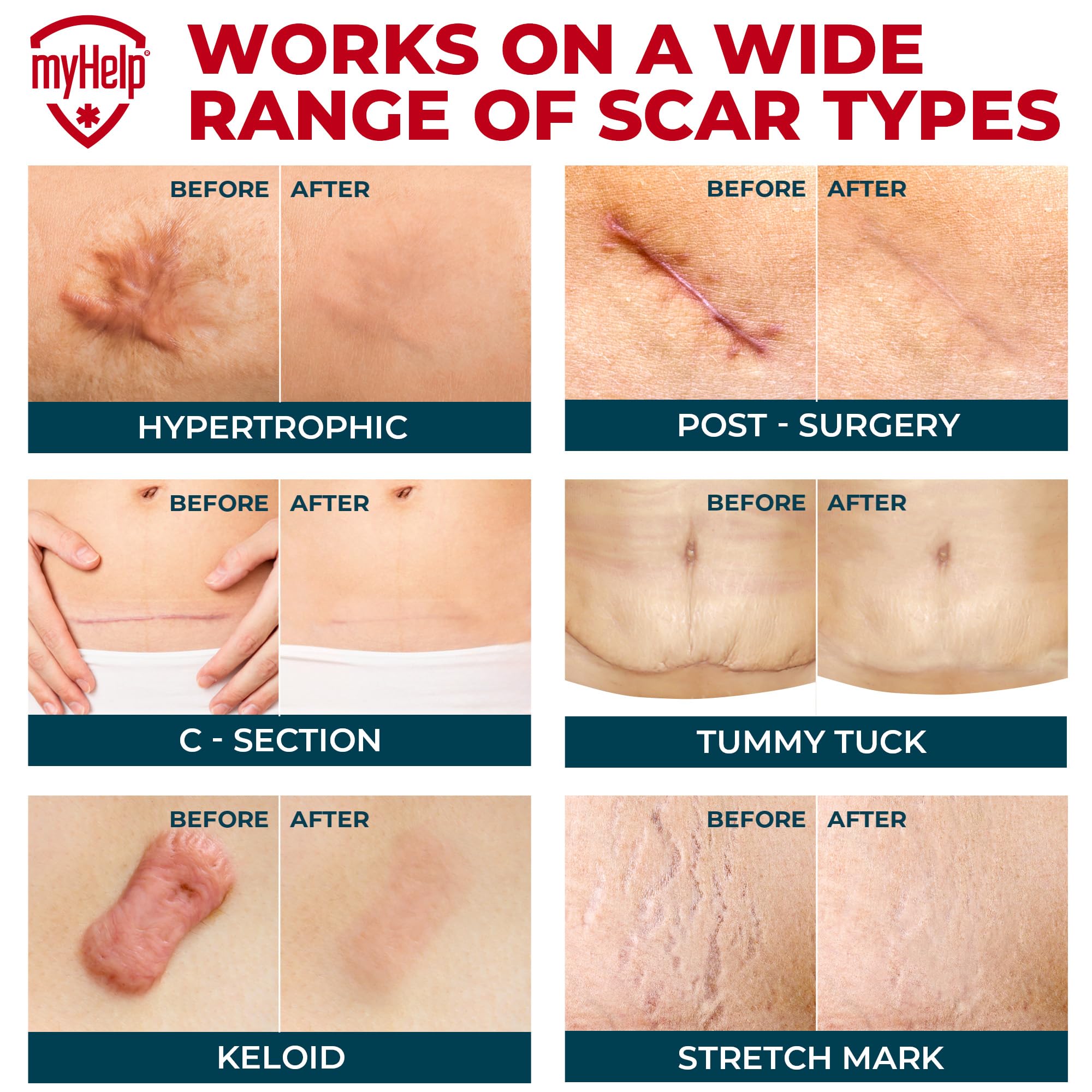 MYHELP breathable silicone scar sheets are soft and comfortable for extended wear.