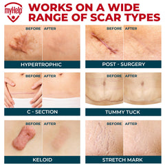 MYHELP breathable silicone scar sheets are soft and comfortable for extended wear.