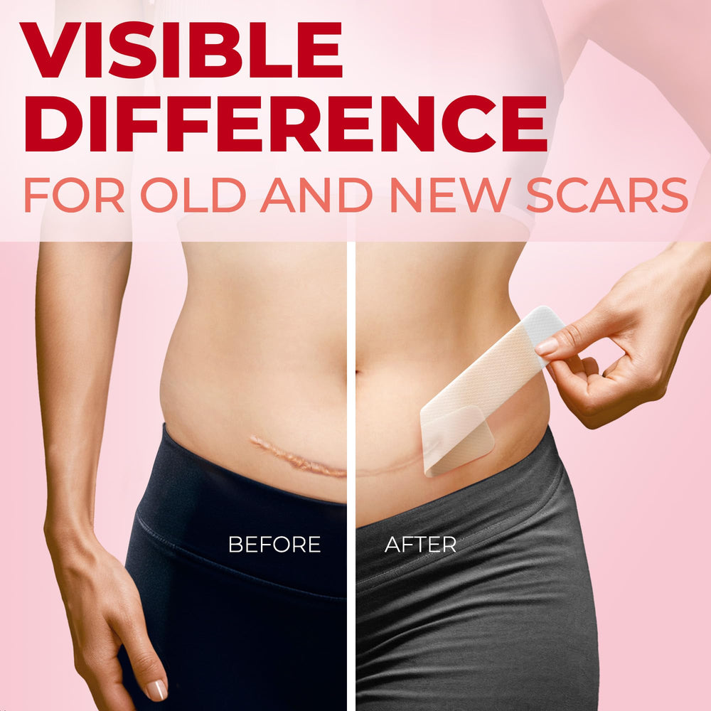 MYHELP C-section scar patch with strong adhesion for secure wear