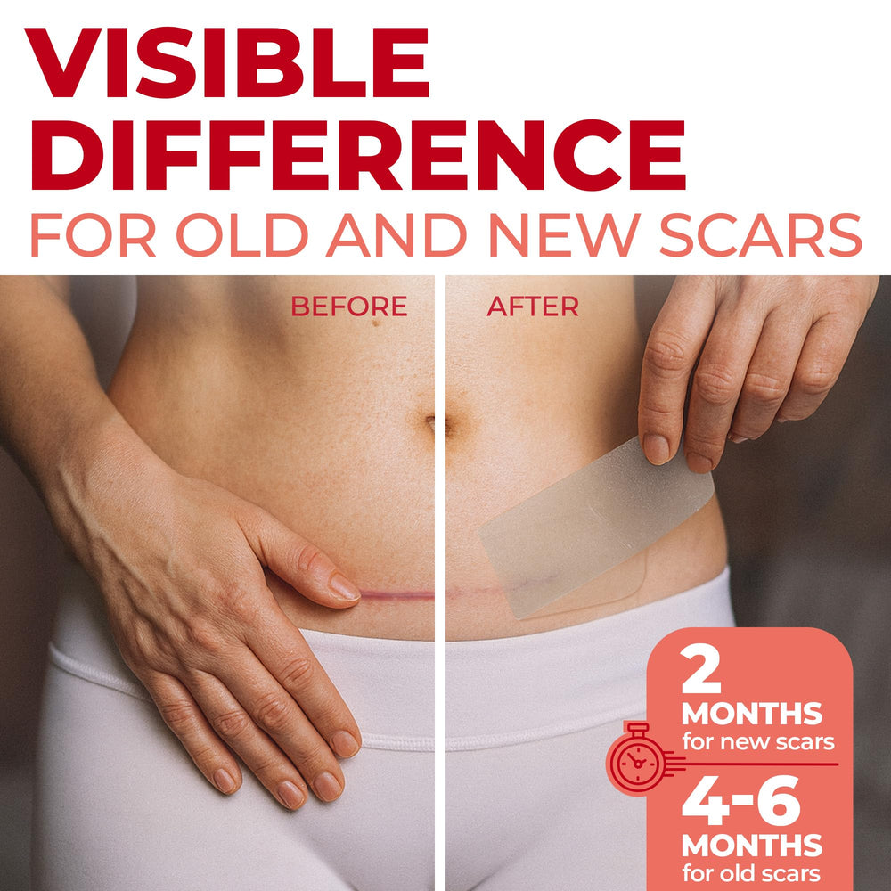 MYHELP C-section scar patch with strong adhesion for secure wear
