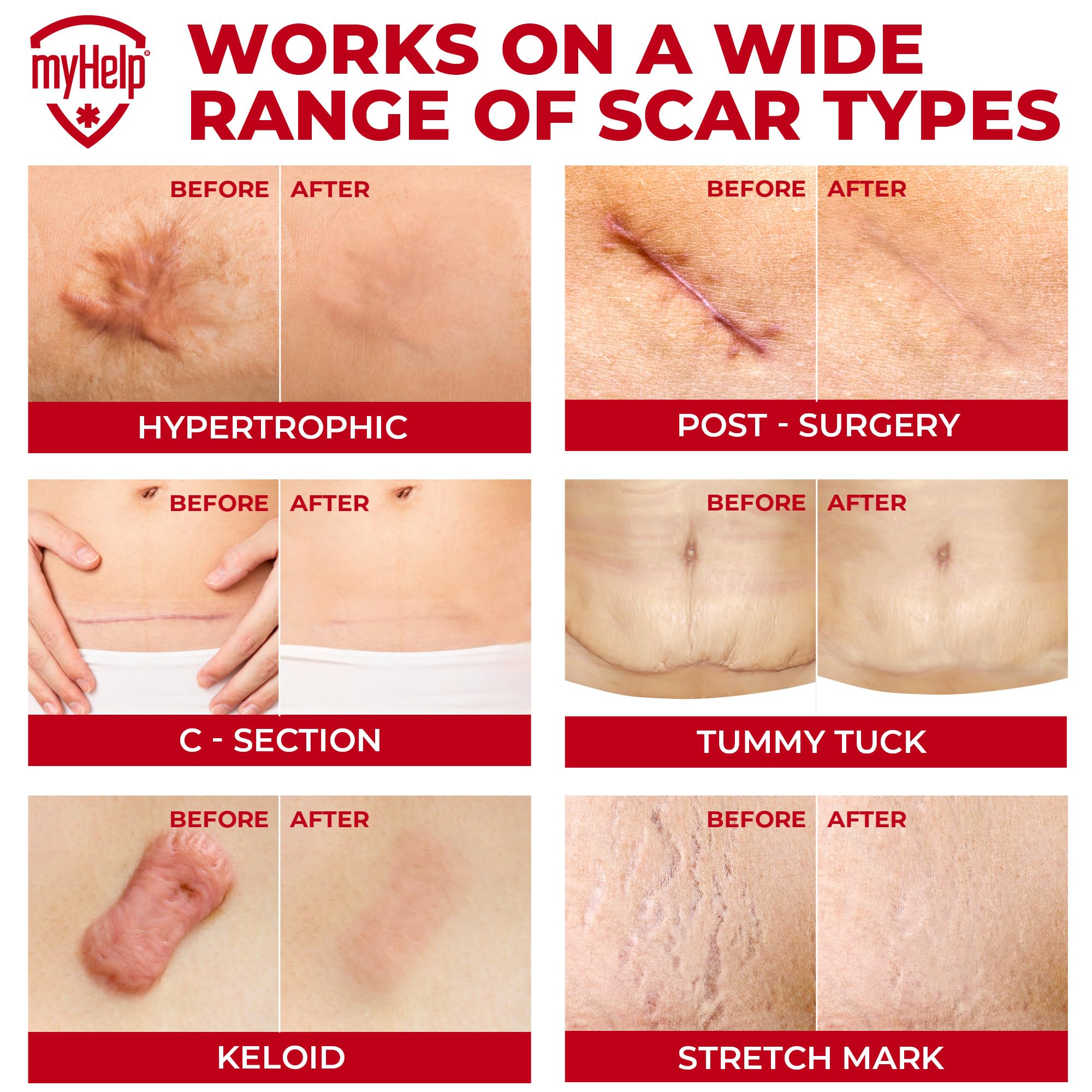 MYHELP flexible silicone strips fit facial and body scars effectively