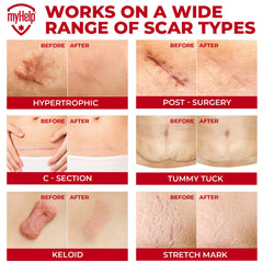 MYHELP flexible silicone strips fit facial and body scars effectively