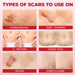 MYHELP flexible silicone strips fit facial and body scars effectively