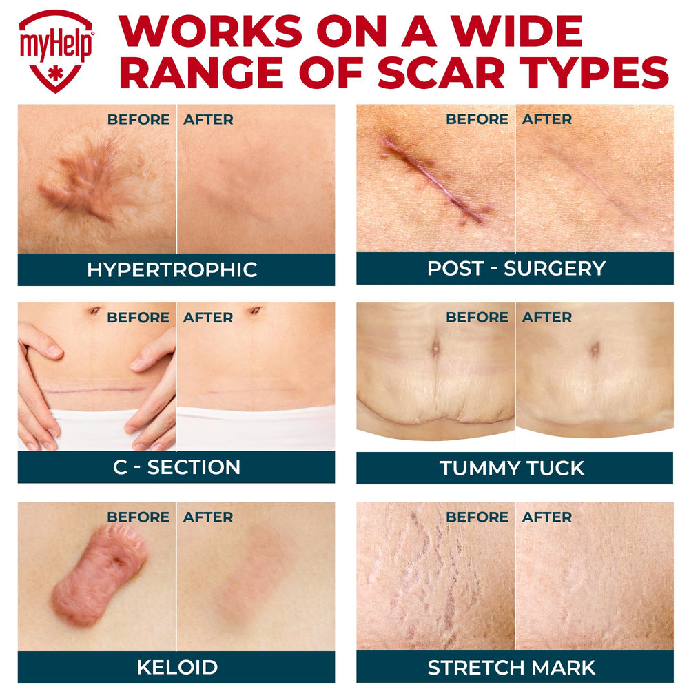 MYHELP scar-sheet holder keeps sheets organized between uses