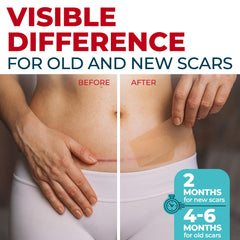MYHELP scar tape applied to face demonstrates easy sizing for precise coverage