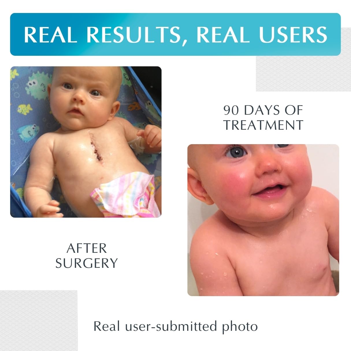 MyNewGel Advanced Scar Sheet adhesive tape detail enables secure wear on joints