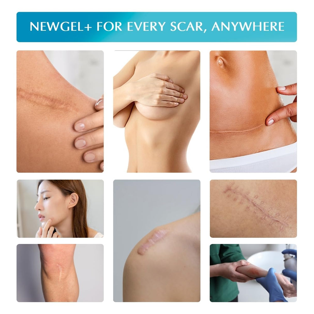 MyNewGel Advanced Scar Sheet retail pack shows four sheets for convenience
