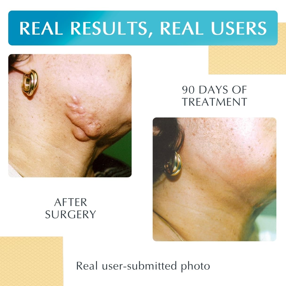 MyNewGel sheet applied to scar area demonstrating comfortable protection