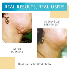 MyNewGel sheet applied to scar area demonstrating comfortable protection