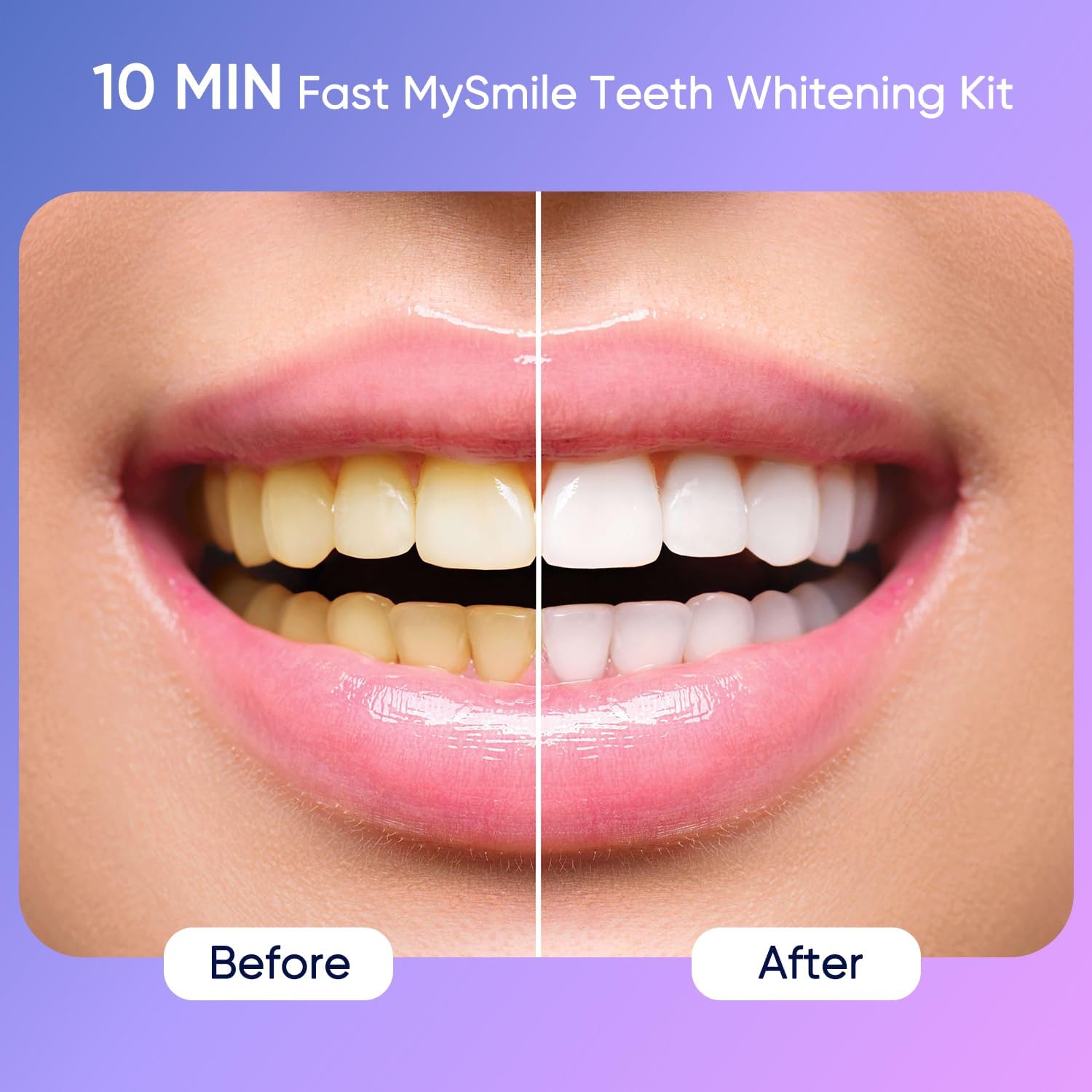 Gel bottle showing 35% carbamide peroxide in MySmile kit