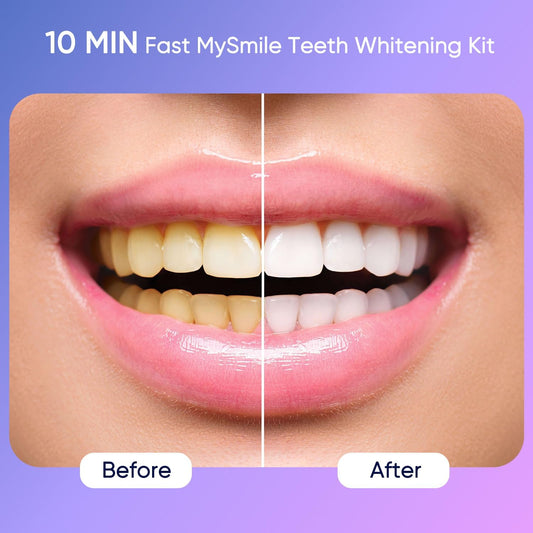 Gel bottle showing 35% carbamide peroxide in MySmile kit