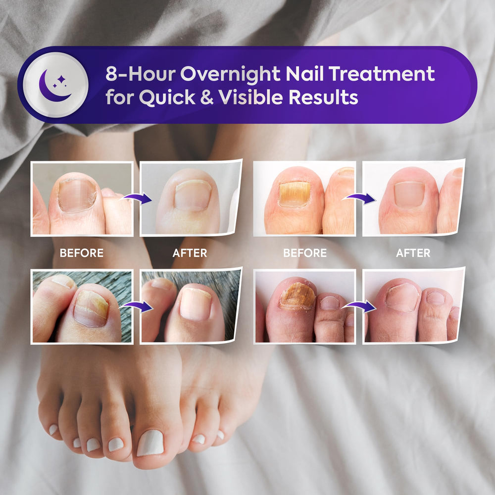 Natural Vine patches toenail close-up shows patch adherence and protective barrier.