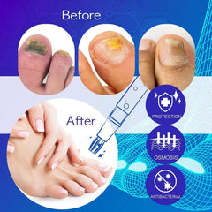 NEOMEN Nail Fungus Pen discoloration improvement close-up of nail color restoration.