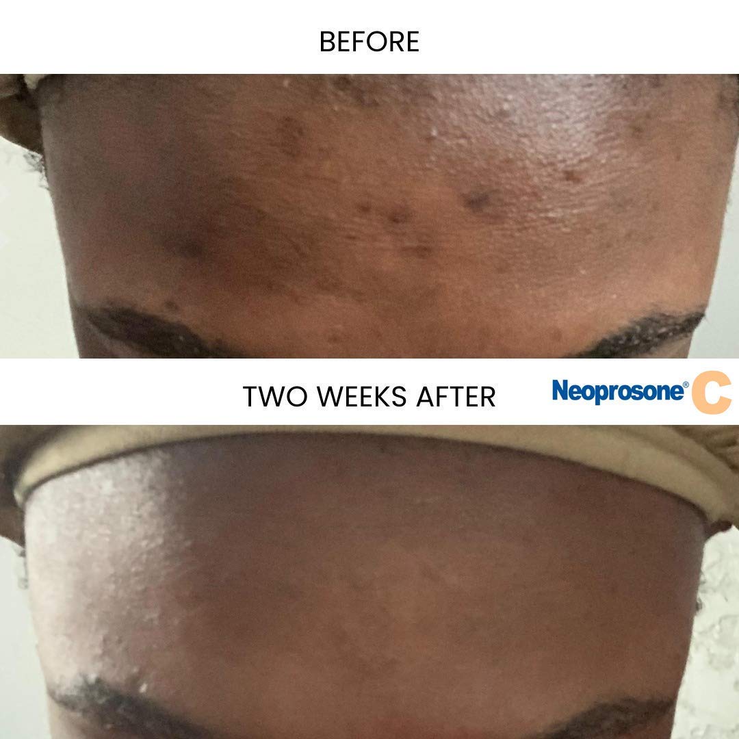 Neoprosone Vitamin C Serum being applied to the cheek for smooth absorption