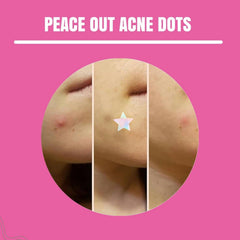 Neva Nude SpotStix polka-dot patch blends with skin while healing