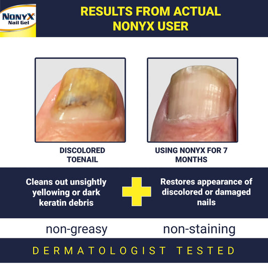 NONYX Fungal Nail Clarifying Gel application shot shows easy daily use for nail appearance.
