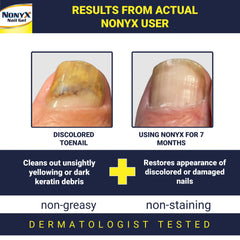 NONYX Fungal Nail Clarifying Gel application shot shows easy daily use for nail appearance.