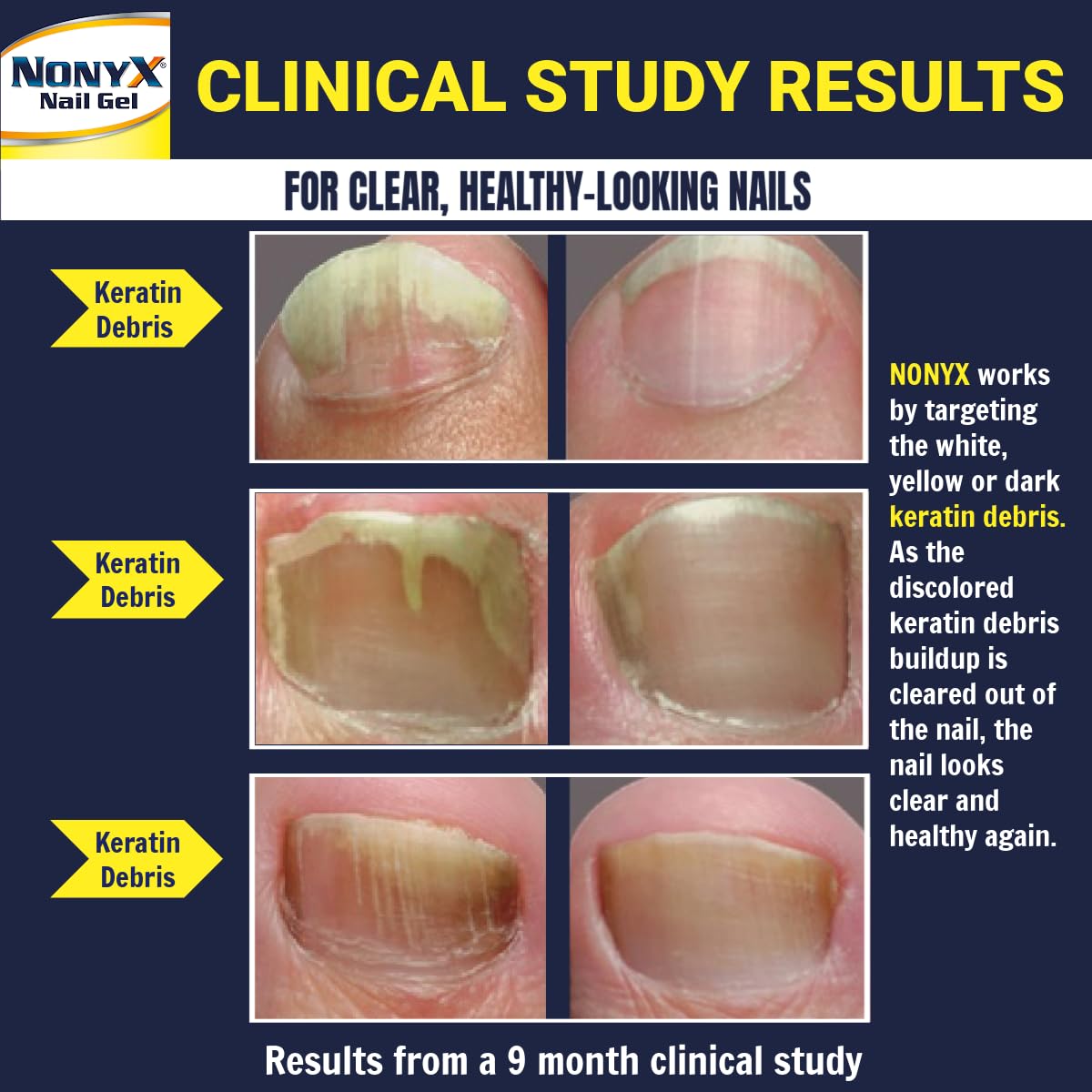 NONYX Fungal Nail Clarifying Gel closeup nails highlights improved coloration and smooth texture.