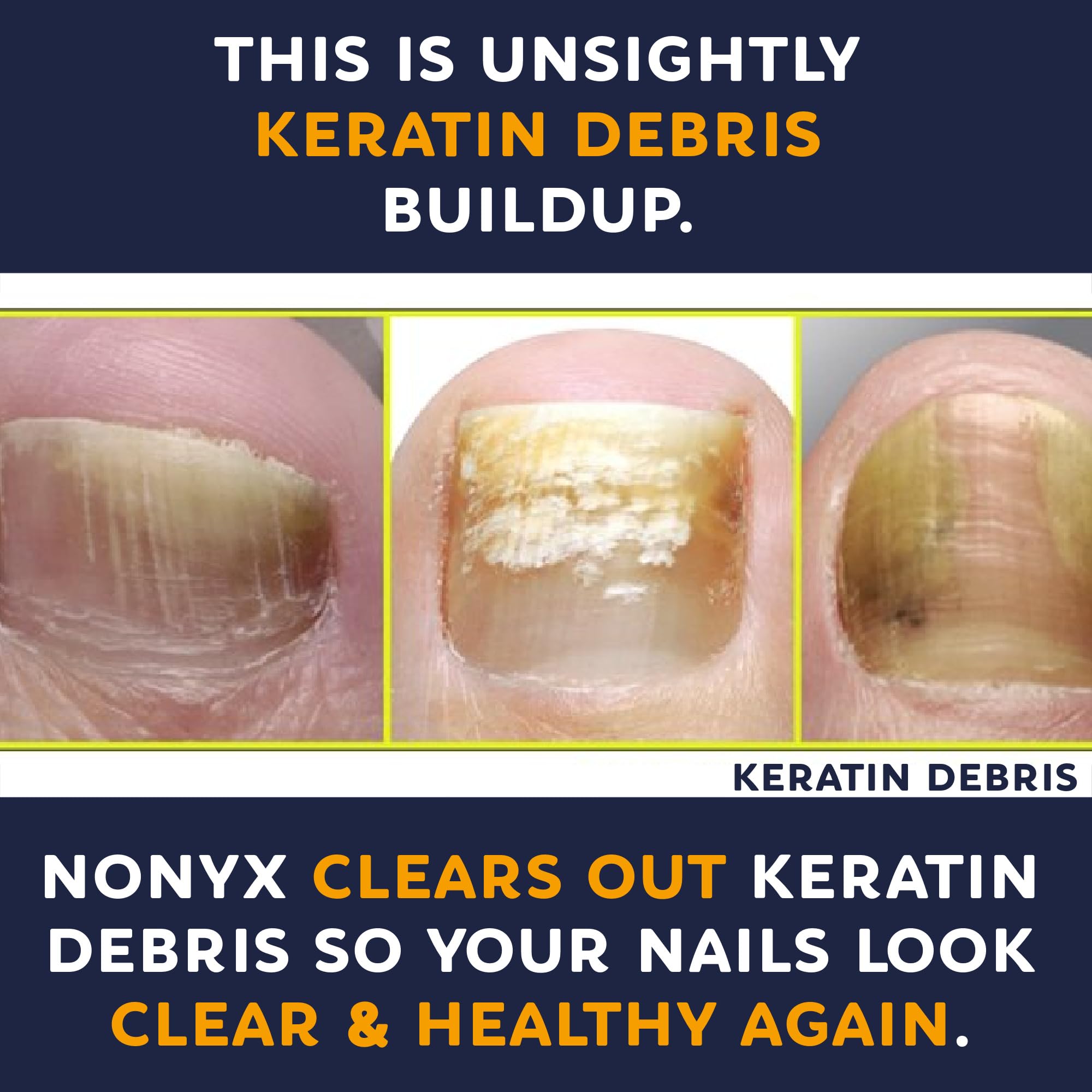 NONYX Fungal Nail Clarifying Gel six-month supply packaging emphasizes value.