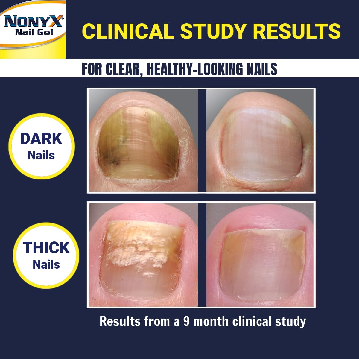 NONYX Fungal Nail Clarifying Gel under polish demonstrates compatibility with acrylic-based polishes.